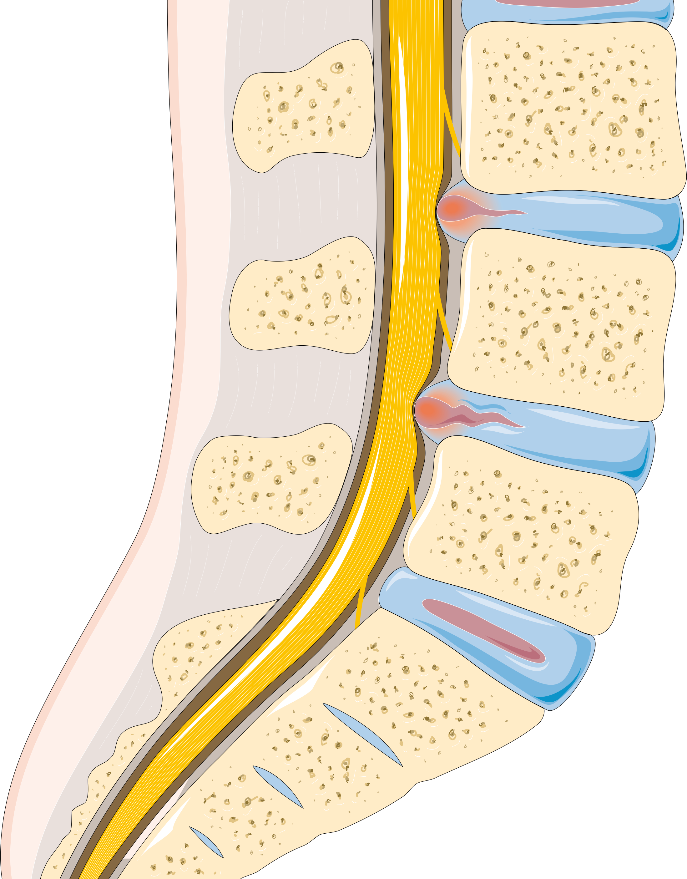 Анатомическая иллюстрация грыжи межпозвонкового диска