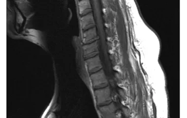 Грыжа, протрузия, остеохондроз: остеопатия вместо операции