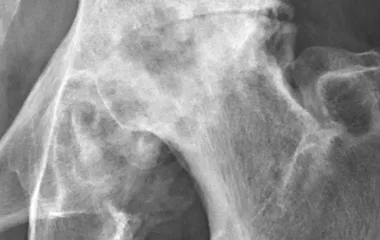 Коксартроз и артроз суставов: остеопатия вместо эндопротезирования