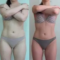 Антицеллюлитный массаж - Контур-подход