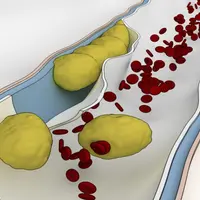 Вся правда о болезни сердца: как сократить риск