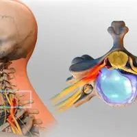 Реабилитационный фитнес при межпозвоночных грыжах