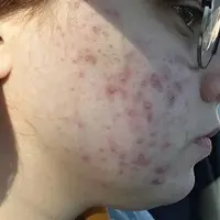 Чистая кожа лица без акне. Секреты косметологов по уходу