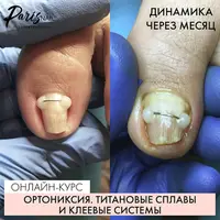 Ортониксия. Титановые сплавы и клеевые системы