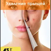 Удаление прыщей