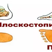 Программа по плоскостопию в домашних условиях