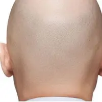 Алопеция: причины и последствия. Современные подходы к терапии