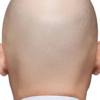 Можно ли вернуть волосы лишь коррекцией внутренних нарушений? Зачем нужен трихолог