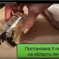 Остеохондроз. Лечение пиявкой