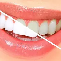 Мощная очаровательная улыбка Плюс + 11x