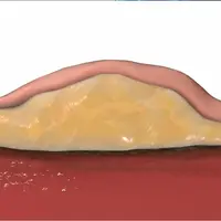 Lipoma Treatment Powerful Plus + 11x