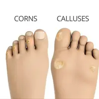 Исцеление натоптышей и мозолей