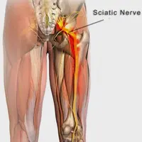 Заживление и регенерация седалищного нерва