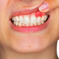 Регенерация десен Powerful Plus + 11x (Extra Strong)