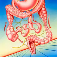 Синдром раздраженного кишечника