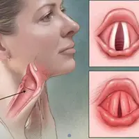 Ларингит. Заживление и регенерация гортани