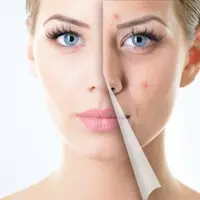 Лечение акне