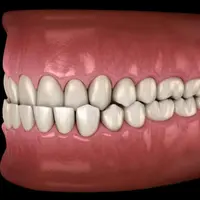 Выравнивание прикуса