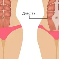 Диастаз! Что делать?