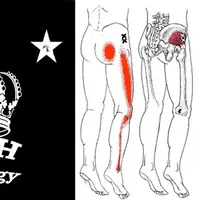 Боли при синдроме грушевидной мышцы