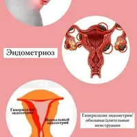 Школа здоровья: Эндометриоз