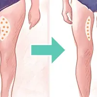 Подтяжка внутренней поверхности бедра