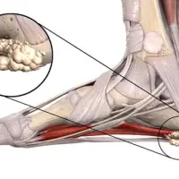 Как избавиться от пяточной шпоры навсегда
