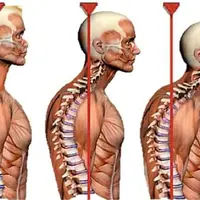 Практические примеры коррекции осанки и фигуры в сагиттальной плоскости
