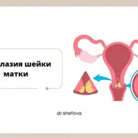 Дисплазия шейки матки