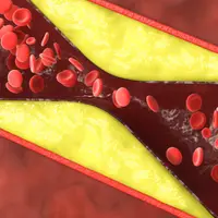 Инфаркт, статины, холестерин — сложнее, чем мы думали