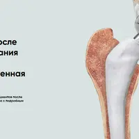 Протокол реабилитации после эндопротезирования тазобедренного сустава