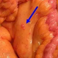 Аюрведа на страже здоровья. Аюрведический подход к лечению рака