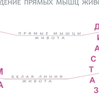 Коррекция диастаза