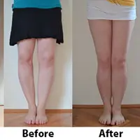 Упражнения для коррекции кривизны ног без операции